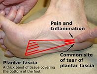 Image result for Plantar Fascia Ligament Pain