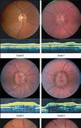 Image result for Papilledema