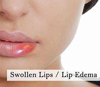 Image result for Bug Bite On Lip