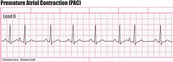 Image result for Premature Atrial Contraction