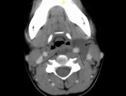 Image result for Retrocaval Cyst