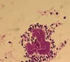 Image result for Actinomycetoma