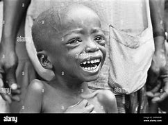 Image result for Starving Ethiopian Child