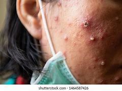 Image result for Viral Pustules