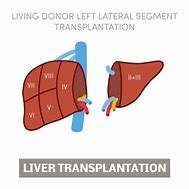 Image result for Liver Transplant Clip Art