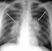 Image result for Chest X-ray of TB