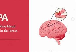 Image result for Stroke Cure