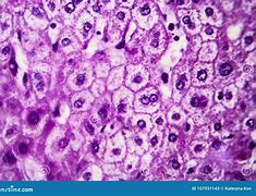 Image result for Swelling of Liver