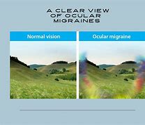 Image result for Signs of an Ocular Migraine