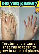 Image result for Teratoma Brain Tumor