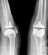 Image result for Left Knee Arthroplasty