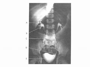 Image result for Right Ureter X-ray