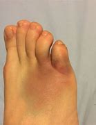 Image result for Broken Toe Bone