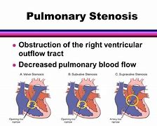 Image result for Right Ventricular Outflow Tract