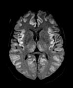 Image result for Hepatic Encephalopathy MRI