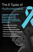 Image result for Hydrocephalus