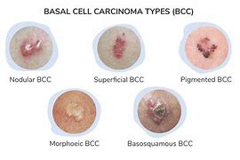 Image result for Basal Cell Carcinoma Lesions