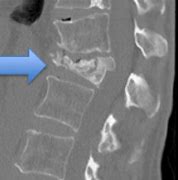 Image result for Compression Fracture Lumbar Surgery