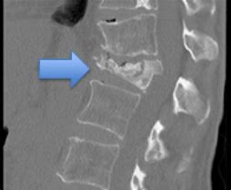 Image result for Imagees Compression Fracture of Lumbar Vertebrae