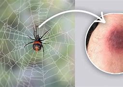 Image result for Widow Spider Bites Blue