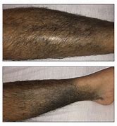 Image result for Dark Pigmentation On Legs