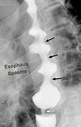 Image result for Esophageal Sphincter Spasm