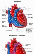 Image result for Complete Atrioventricular Canal Defect