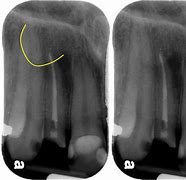 Image result for Lateral Tooth