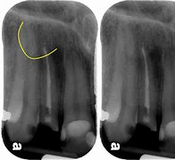 Image result for What Is a Lateral Tooth