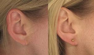 Image result for Torn Ear