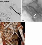 Image result for Selective Catheter Placement From Brachial Approach