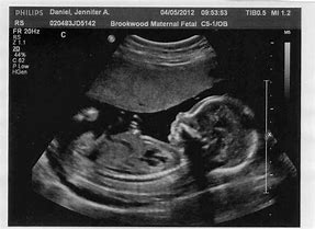 Image result for Baby Sonogram