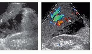 Image result for Biloma Ultrasound Images Post-Cholecystectomy