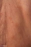 Image result for Sclerotic Atrophy of Skin