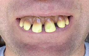 Image result for Brown Teeth Laugh