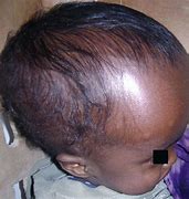 Image result for Hydrocephalus