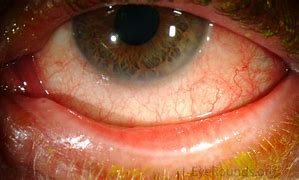 Image result for Conjunctival Papillae