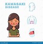 Image result for Kawasaki Virus Symptoms