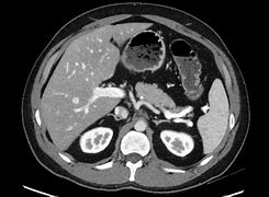 Image result for Spleen Enlargement CT