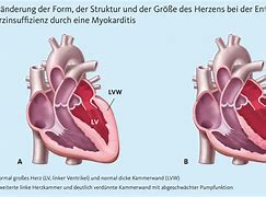 Image result for Myokarditis