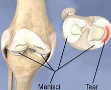 Image result for Meniscal Tear Treatments