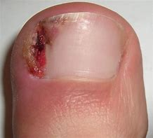 Image result for Ingrown Nail