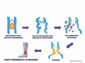 Image result for Post-Thrombotic Syndrome