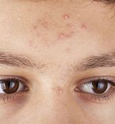 Image result for People with Pimples