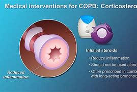 Image result for Best Treatment for COPD Illustration