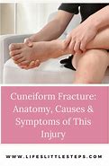 Image result for Cuneiform Fracture