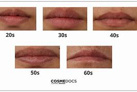 Image result for Upper Lip Wrinkles