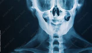 Image result for Kidney On X-ray