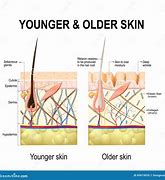 Image result for Skin Atrophy Diagram