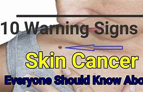 Image result for 5 Warning Signs of Skin Cancer